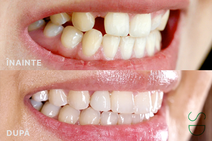 Implantologie dentara cu tehnologie moderna la stomatolog Ovidiu Constanta